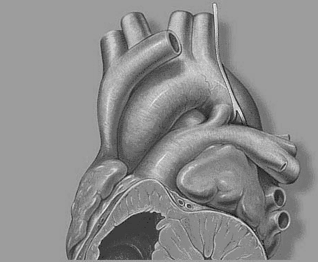 PERVIETA DEL DOTTO DI BOTALLO Il Dotto di Botallo, che mette in connessione l arteria polmonare con l aorta, è sempre pervio nella vita fetale: chiusura funzionale a 12-20 ore dalla nascita fibrosi.