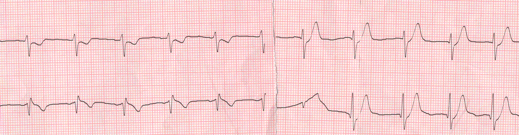 tabagismo (40 50 S/die) e dislipidemia.