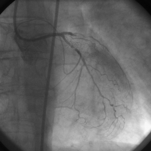 Occlusione di discendente anteriore Stenosi