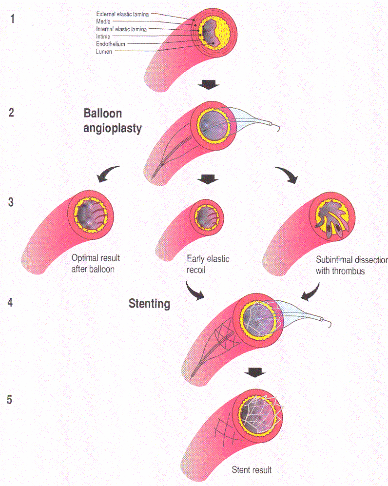 Percutaneous Coronary Intervention MJ