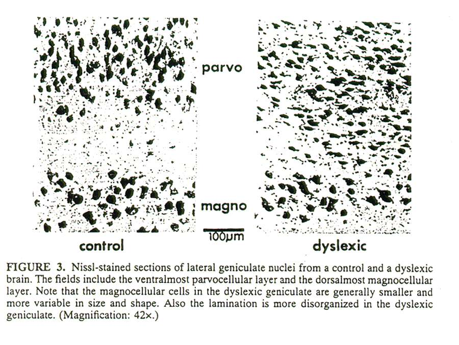 Anomalie strutturali microscopiche Nucleo genicolato laterale: Nei dislessici le cellule dello