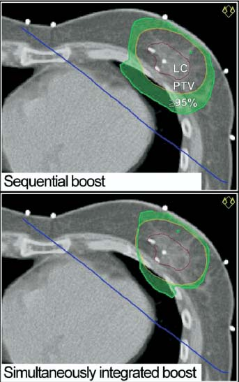 49GY BOOST GIORNALMENTE) VS SEQUENTIAL BOOST:32 FRTOT(50Gy+16GY)