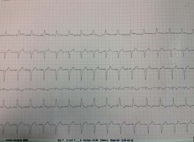 Figura 1. ECG all arrivo in DEA ospedale spoke. EGA in occhialini 6 L/m: ph 7.