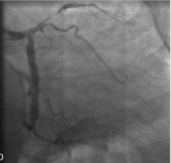 La coronarografia viene eseguita da approccio radiale destro e documenta una lunga lesione sub-occlusiva dell arteria interventricolare anteriore al primo tratto, con flusso a valle TIMI 0-1.