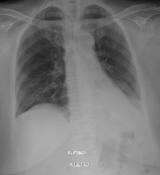 Andamento radiologico 30/11/2015 si apprezza una lieve riduzione per dimensioni