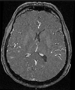 4. USARE LE SCANSIONI DEL PAZIENTE APPROPRIATE Non usare scansioni MRI distorte per la registrazione. Se disponibile, usare la correzione della distorsione 3D per tutte le scansioni.