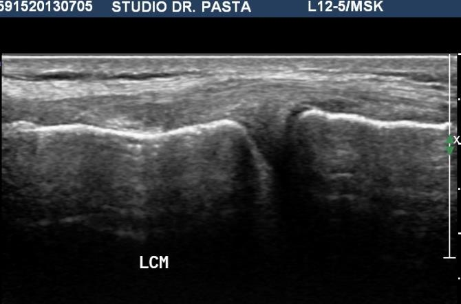 prossimale RMN Struttura lineare ipointensa dal margine 