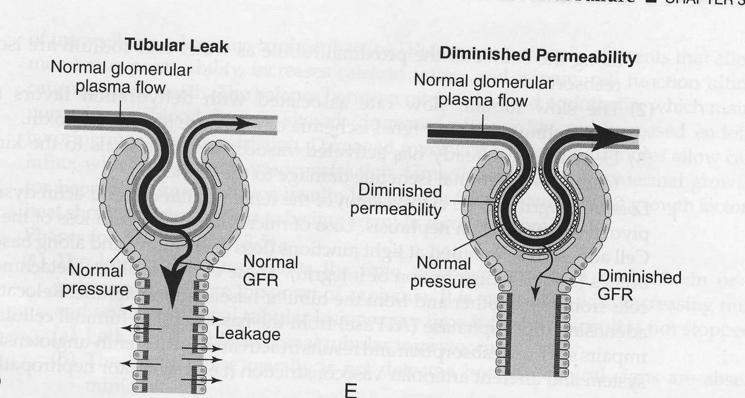 Azotemia e oliguria Danneggiamento tubulare (rottura dell epitelio - backleak) Ostruzione intraluminare del tubulo da cilindri, materiale cellulare, edema Ostruzione extraluminale del