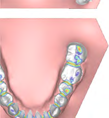 Il nostro modulo avanzato è stato progettato per l esame e l analisi dei modelli digitali dentali scansionati con le