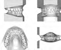 Calco in gesso Scansione dell impronta Pianificazione del trattamento in 3D Analisi del modello dentale Le scansioni