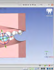 configurazione virtuale dei denti, visualizzando contemporaneamente intercuspidazioni e contatti.