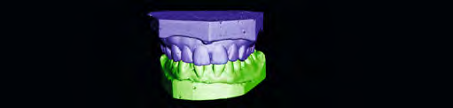 Misurazione, confronto e monitoraggio dei cambiamenti nei movimenti dei denti Scansione dell impronta per un modello digitale