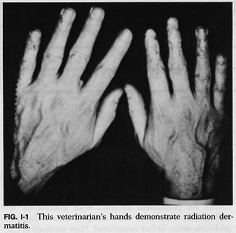 Patologia deterministica cutanea Radiodermatosi (cute del radiologo) Consegue ad esposizioni protratte a dosi di radiazioni alle mani tipiche dell epoca eroica della radiologia.