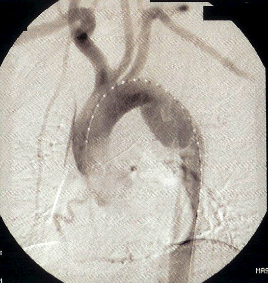 Informazioni di Imaging Angio TAC spirale È necessario eseguire una scansione TC per l'esame dei grossi vasi dell'arco aortico, del