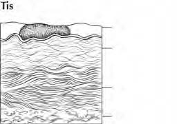 FIGURA.4. Carcinoma in situ. Epidermide Derma papillare Derma reticolare Tessuto sottocutaneo liquido linfatico. Le stazioni linfonodali regionali sono illustrate nelle Figure.1,.2 3.