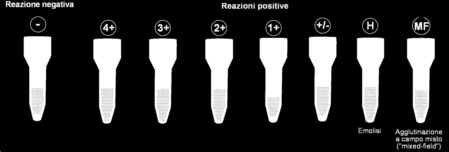 Ricerca di Anticorpi (RAI) Il Sistema Ortho Biovue - Ricerca di Anticorpi (RAI) 35 Quando la ricerca di anticorpi produce una reazione positiva di agglutinazione, tale reazione varia nella sua