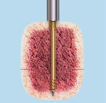 Tecnica chirurgica per HCS 4.5 e 6.