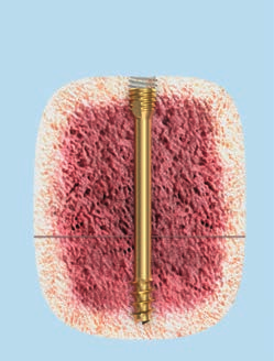La posizione della linea di frattura determina la lunghezza del filetto Lunghezza corretta del filetto Il filetto del gambo viene a trovarsi sotto la rima di frattura e completamente entro il