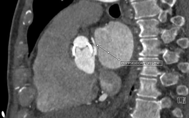 Caso clinico 11/2012 SVAo in urgenza su protesi fissurata 12/12-3/13 ICU multipli eventi settici 4/13 riabilitazione cardiologica 7/13 TIA + VII centrale, iperpiressia