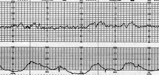 Frequenza cardiaca Linea di base 110-160 bpm Almeno 10 minuti di tracciato Assenza di variazioni