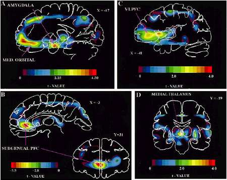 Correlati neurometabolici delle emozioni ruolo contrapposto dell amigdala, della corteccia orbitofrontale mediale e ventrolaterale rispetto alla corteccia prefrontale sottogenicolata nella tristezza