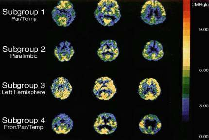 Alzheimer s Disease: Correlation