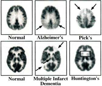 PET in the Evaluation of Dementia: Differentiating