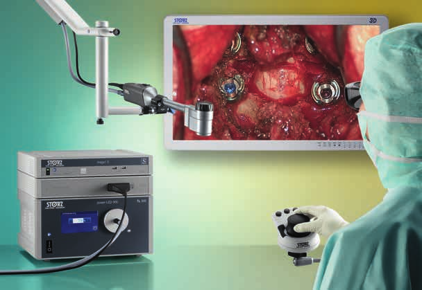 VITOM 3D Visualizzazione 3D per la chirurgia aperta della colonna vertebrale Il sistema VITOM 3D rappresenta una soluzione di visualizzazione rivoluzionaria per interventi di microchirurgia e di