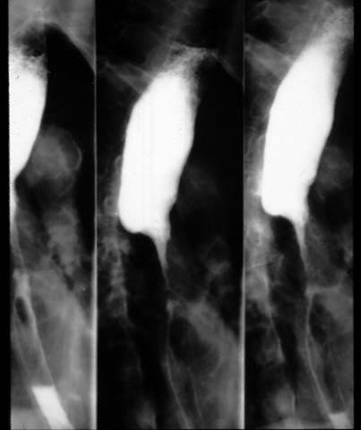 X-RAY: UGI film shows barium within the esophagus.