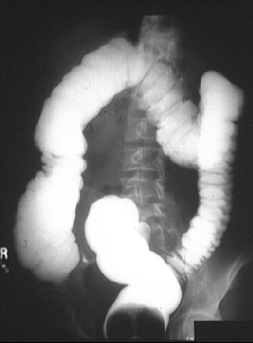 X-RAY: Barium enema.