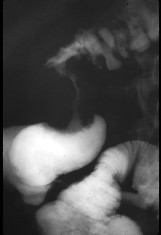 X-RAY: There is abrupt narrowing of the lumen of the ascending colon.