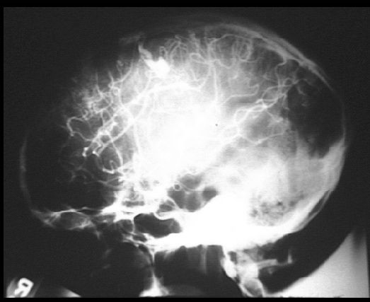 ANGIOGRAFIA Conventional cerebral angiogram performed with a catheter in the right internal carotid