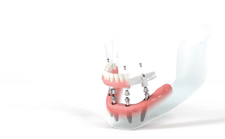 Straumann Pro Arch è una soluzione completa che comprende una notevole gamma di impianti, componenti secondarie, strutture CADCAM, barre, ponti e altre componenti che permettono a dentisti e