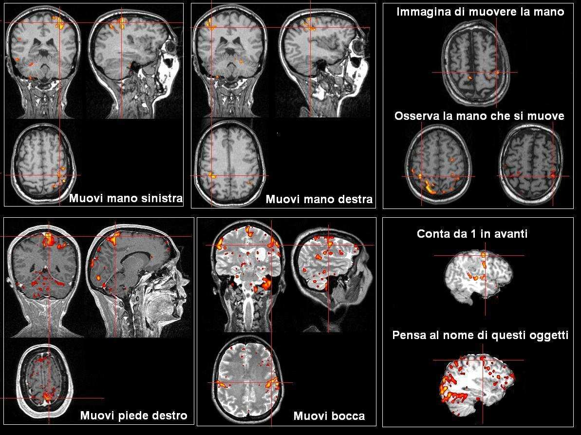 In alto attivazione della rappresentazione della mano durante l esecuzione di movimenti ripetitivi delle mani o durante l