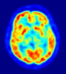 In basso attivazione della rappresentazione cerebrale del piede durante l esecuzione di movimenti ripetitivi del piede