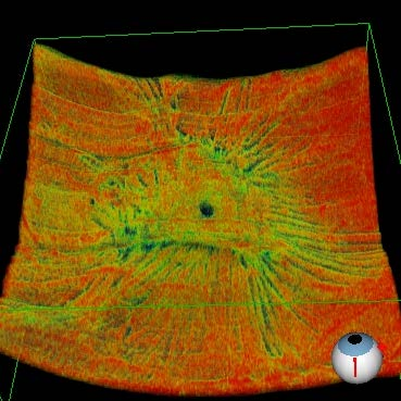 2.1 Vitreoschisi PVD Anomalo slaminamento nella corteccia vitreale posteriore Gli Ialociti rimasti sulla superficie retinica possono stimolare la