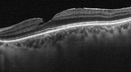 Criteri di esclusione: Altre patologie oculari Miopia 6 diottrie Tutti I