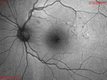 METODI Ad ogni Follow up: Autofluorescenza del fondo oculare: Normale Ipofluorescente Iperfluorescente SD-OCT scans: Presenza di VPA-12 mm