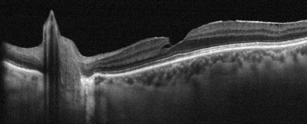 Romano, vitreo-papillary adhesion as prognostic factor in pseudo and lamellar macular holes, Eye
