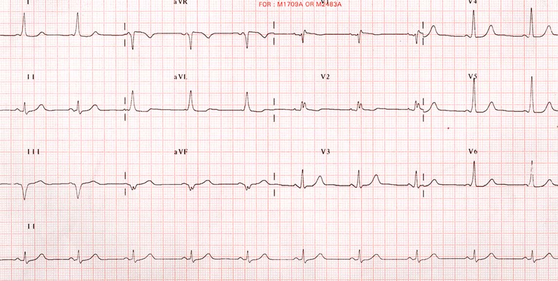 Capitolo 17 Anomalia di Ebstein della valvola tricuspide 153 Figura 17.2 Elettrocardiogramma (ECG) a 12 derivazioni di un paziente con anomalia di Ebstein della valvola tricuspide.