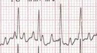 04 sec P/QRS>1 (FC atriale 460 bpm) Rientro Atri Nodo