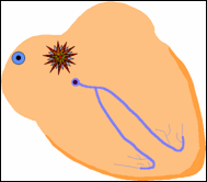 Tachiaritmie in età neonate/pediatrica altro meccanismo