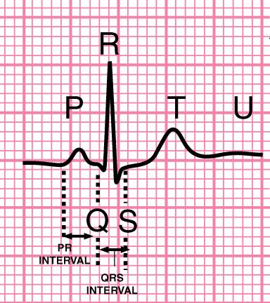 morfologia ed asse frequenza > 180 variabile con l attività Complesso QRS presente normale morfologia