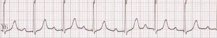 Blocco atrioventricolare I grado Asintomatico Ritardo di conduzione nel nodo AV nell 80% nel tratto AH Non provoca bradicardia o instabilità emodinamica; PR> 160ms 280 msec Secondario a ipertono