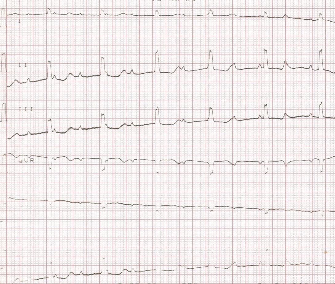 sopra-hissiano, esercizio e atropina aumentano la frequenza del QRS