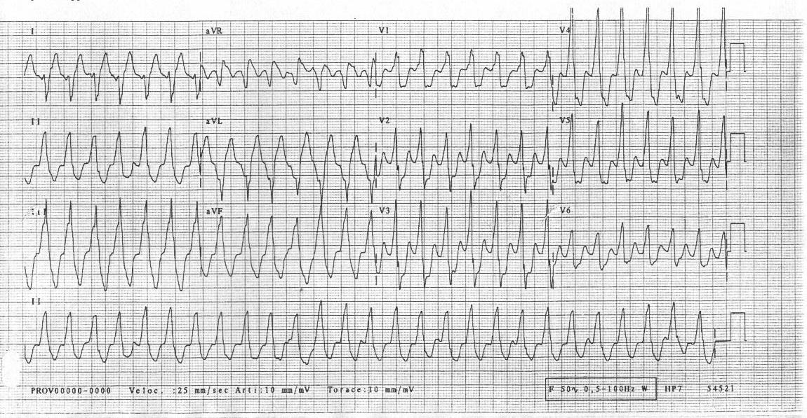 08sec Tachicardia ventricolare QRS larghi > 0.