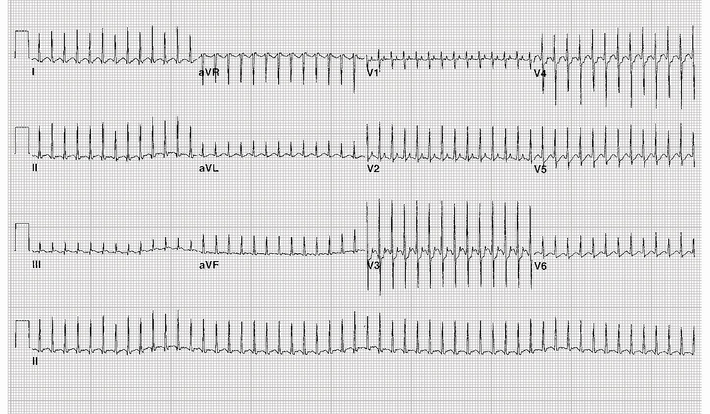 TSV da rientro P :QRS = 1:1 Intervallo RR si