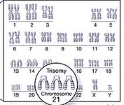 Cause genetiche Anomalie cromosomiche: 10% dei casi - Anomalie cromosomiche