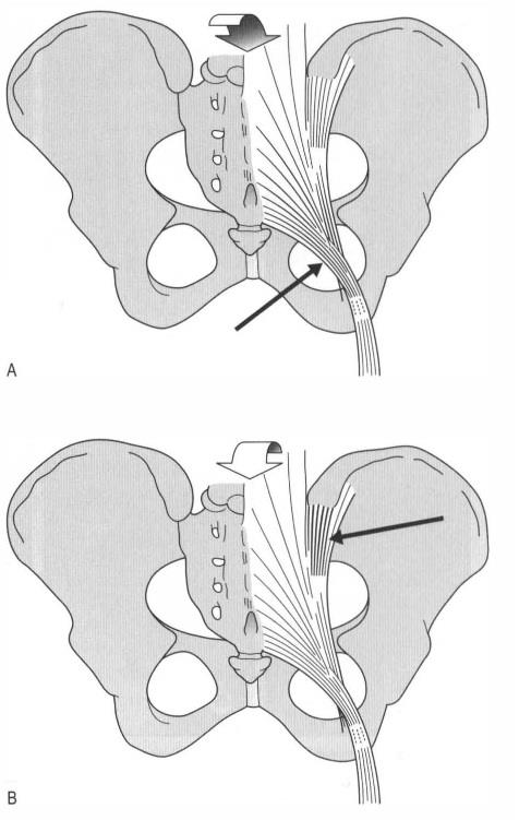 Se prendiamo in considerazione il sacro nell ottica di esaminare un dolore basso alla schiena, allora dobbiamo considerare i sistemi legamentosi di stabilizzazione il legamento sacro tuberoso (A),
