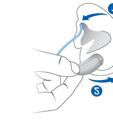 Inserimento L'apparecchio acustico è stato finemente regolato per l'orecchio sinistro e l'orecchio destro.